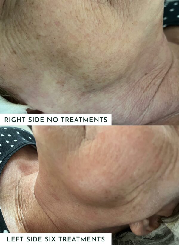 Skin Enhancer Before and After